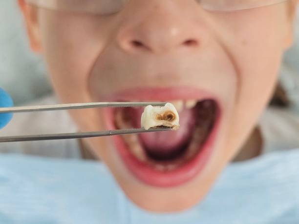 Best Emergency Tooth Extraction in Progress, PA